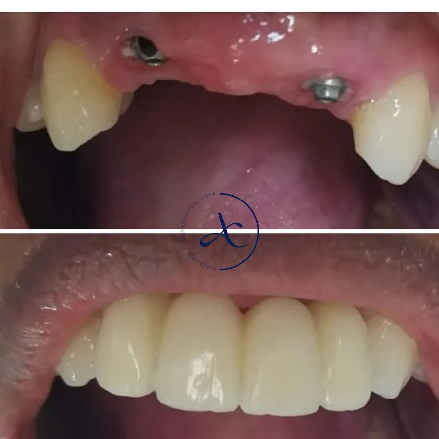 Antes e depois: dentes da frente repostos com implantes
