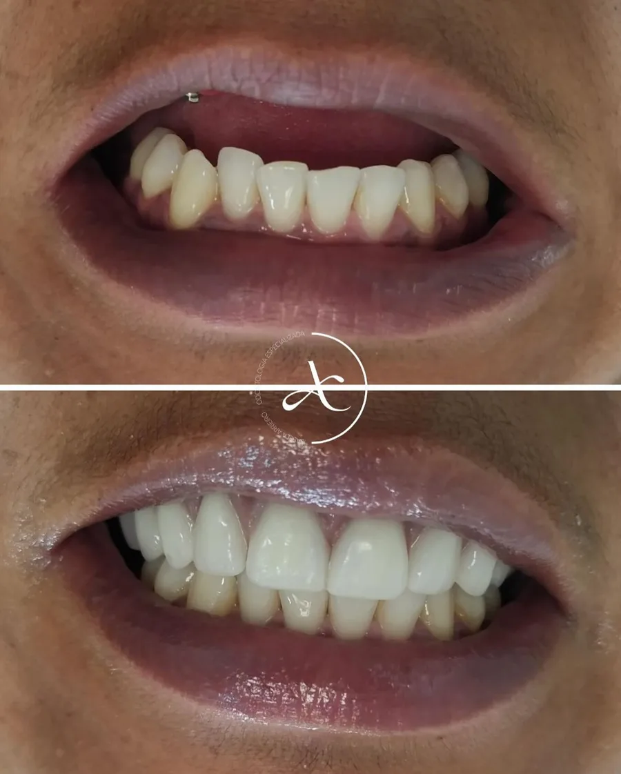 Antes e depois: reabilitação sobre implantes