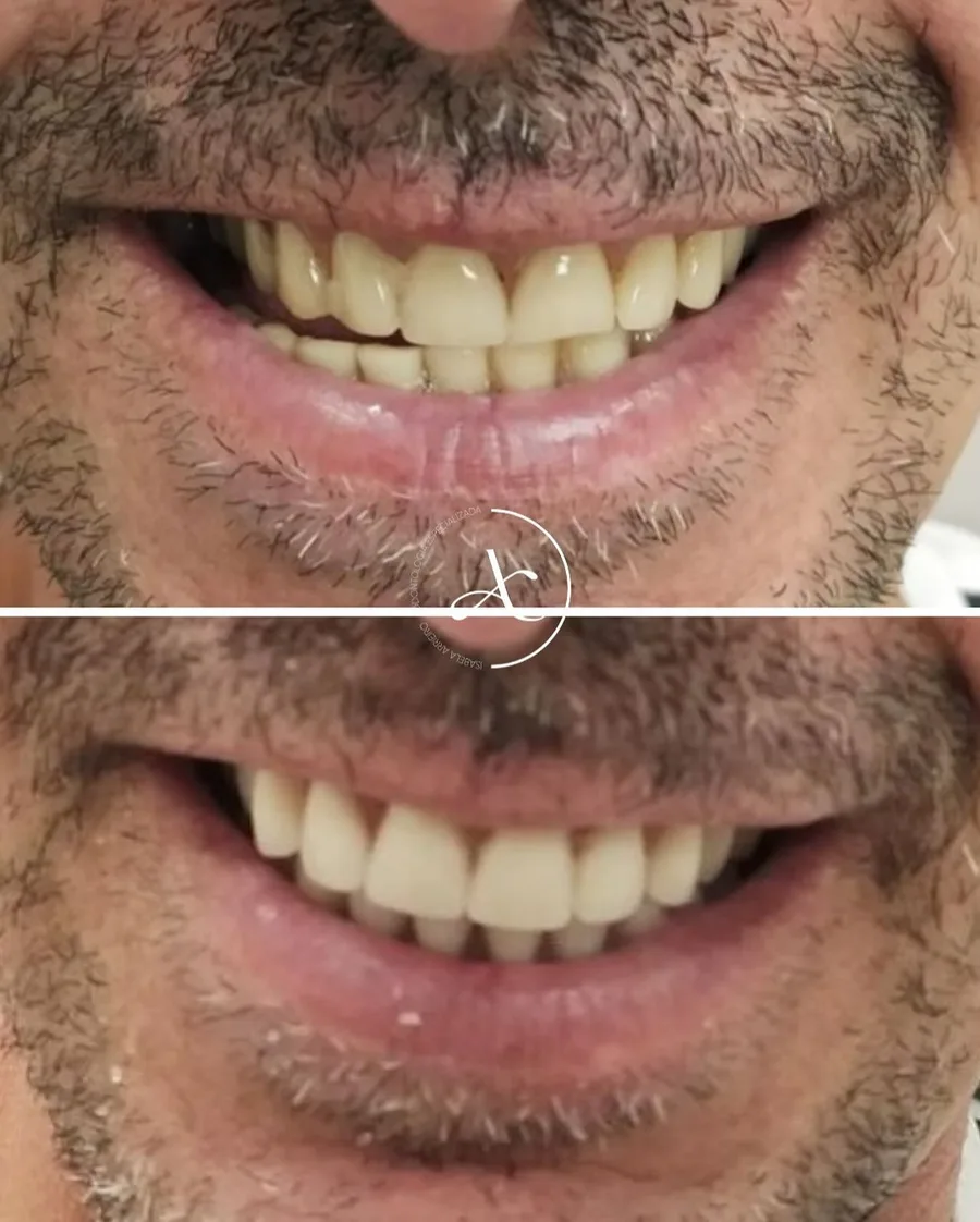 Antes e depois: troca de próteses
