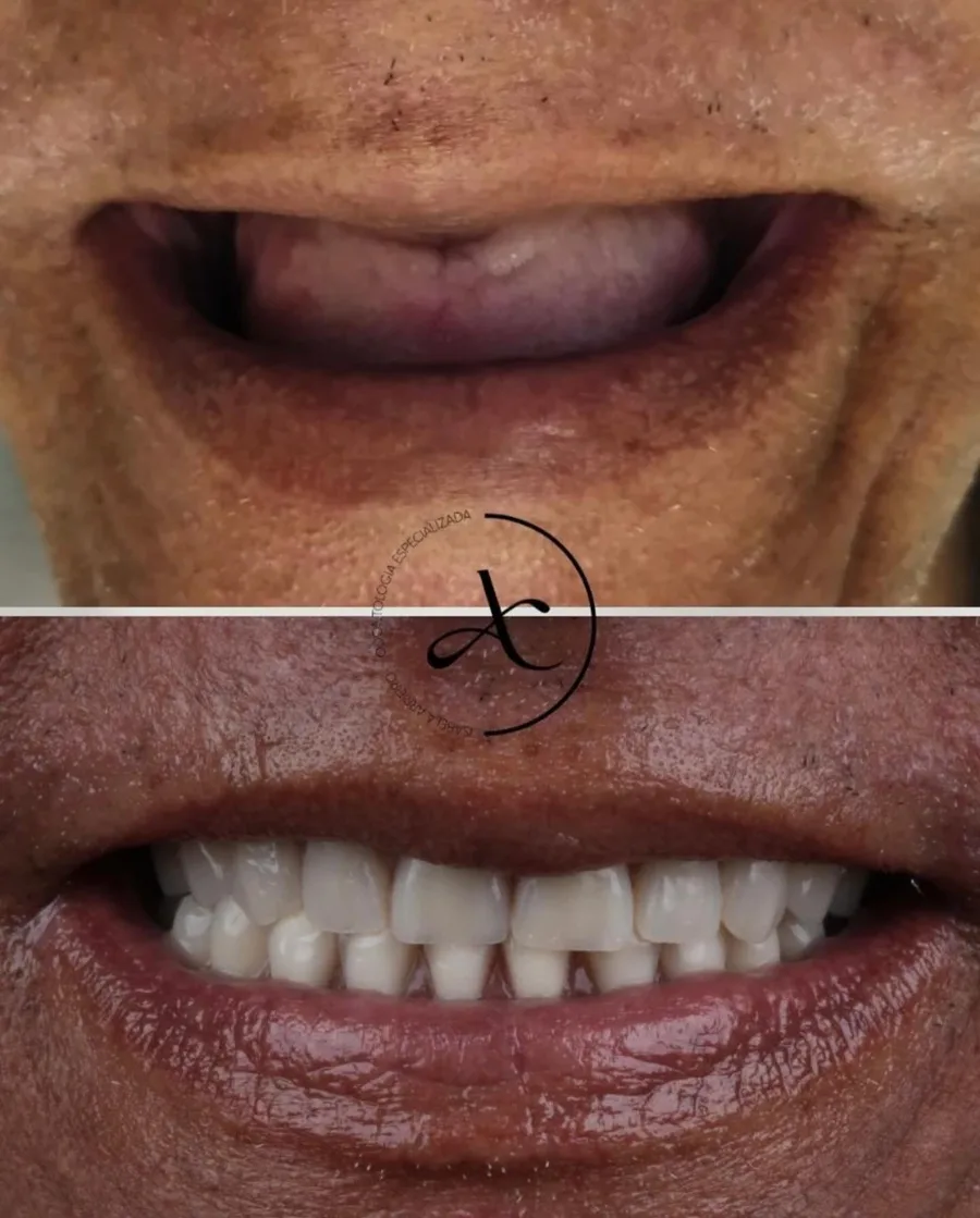 Antes e depois: protocolo sobre implantes
